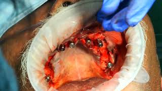 Palatal approachnaso maxillary butresspterygoid to avoid zygomatic implants for atrophic maxilla3 [upl. by Berardo349]