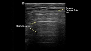 Pneumoperitoneum Enhanced Peritoneal Stripe Sign [upl. by Lamhaj]