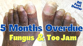 5 Months Overdue Toenail Trimming Fungus and Toe Jam [upl. by Myron]