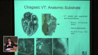 Manejo del paciente con arritmia ventricular quotchagásicaquot [upl. by Wilson]