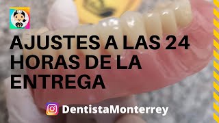 AJUSTES Y Pulido a las 24 Horas 👅PRÓTESIS DENTAL Inferior Parte4 DentaduraCompleta [upl. by Amsaj]