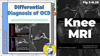 Fig 5B26 Differential Diagnosis of Osteochondritis Dissecans [upl. by Newg176]