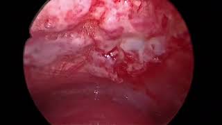 Rigid Thoracoscopy  Pleural Biopsy  Talc Poudrage  Malignant Pleural effusion [upl. by Weixel632]