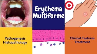 Erythema multiforme [upl. by Dumanian874]