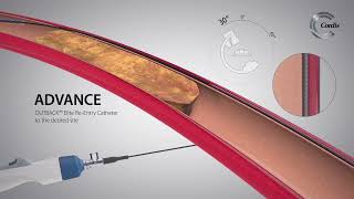 OUTBACK™ Elite ReEntry Catheter Product Highlights [upl. by Riker]