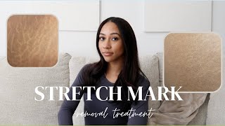 STRETCH MARK REMOVAL TREATMENT MY RESULTS [upl. by Anairad72]