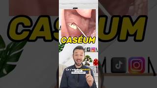 Qu’est ce que le Caséum  tonsil tonsilstones tonsilitis caseum breath breathing santé [upl. by Wiburg]