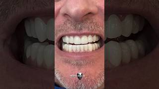 Incredibil™ Snapon Veneer Review  Unmatched Quality [upl. by Favianus]