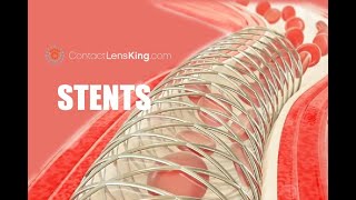 What are Stents How Do Stents Work How are Stents Inserted [upl. by Nylhtak]