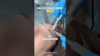 약물을 약침으로 주입하여 콜라겐 재생을 유도하는 MTS mts 스킨부스터 피부관리 콜라겐 피부재생 [upl. by Ynttirb129]