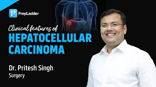 quotClinical features of Hepatocellular Carcinomaquot by Dr Pritesh Singh [upl. by Tremayne]