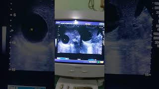 Ultrasound abdomenSimple hepatic cyst [upl. by Greiner]