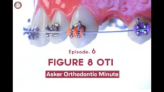 Figure 8 Oti Asker Orthodontic Minute Episode 6 [upl. by Kerge]