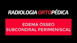 Edema Ósseo Subcondral Perimeniscal [upl. by Ko]