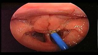 Adenoidectomy Surgery  Removal Of Adenoids  ENT Consultant London  ENT Surgeon London [upl. by Scotney779]