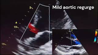 Takayasu Arteritis [upl. by Hussey]