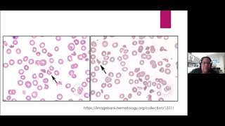 Schistocytes To TPE or Not to TPE [upl. by Anilag878]