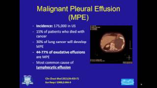 Malignant Pleural Effusion 03102017 [upl. by Chantalle]