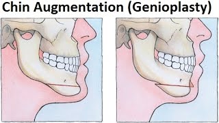 Treatment of Retruded JawsMandible Using GenioplastyMentoplastyChin Augmentation by Dr Mike Mew [upl. by Hamforrd86]