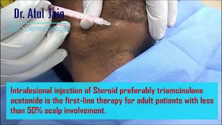 Alopecia Areata  Intralesional Injection of Treatment [upl. by Layap757]