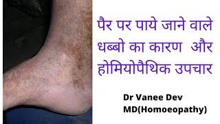 Homoeopathic treatment of Schamberg diseasehomoeopathic medicines for dark spots on leg [upl. by Gerrie]