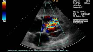 Septal Pseudoaneurysm Post MI [upl. by Agueda637]