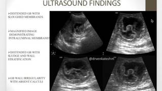 Gangrenous cholecystitis  A rare Entity [upl. by Anar]