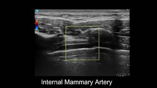 Internal Mammary Artery On Ultrasound [upl. by Jandel]