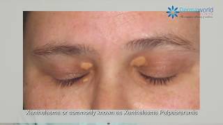 What is Xanthelasma   Dr Rohit Batra explains [upl. by Fiora102]