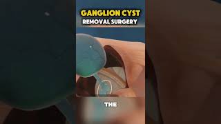 Ganglion Cyst Removal Surgery shortvideo [upl. by Evatsug]