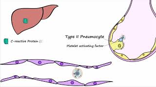 Bacterial Pneumonia  Pathogenesis [upl. by Renita2]