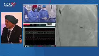 Live Case 1  Impella Supported PCI of Calcified LAD using Rotational Atherectomy and OCT Guidance [upl. by Berg390]