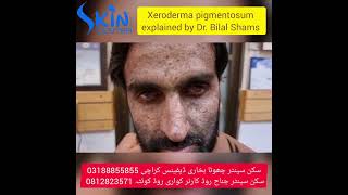 Xeroderma pigmentosum  skin cancer  best dermatologist  Dr Syed Bilal Shams skincenterpakistan [upl. by Osnohpla360]