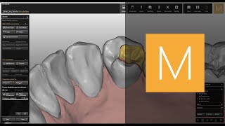 InlaysOnlaysVeneers software module of ZirkonzahnModellier  ZirkonzahnSoftware [upl. by Apps312]