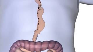 Esophagectomy Procedure Animation [upl. by Onabru]