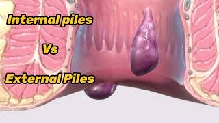 BAADI BAVASIR Vs Khooni Bawasir  Which are different types of Piles amp Haemorrhoids  Piles meaning [upl. by Roybn]