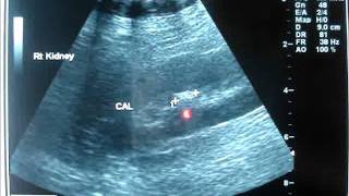 Ultrasound for KIDNEY STONE [upl. by Lanctot]