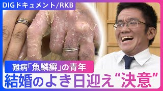 「理解してくれる人は必ずいる」皮膚の難病“魚鱗癬”の青年…諦めなかった結婚と伝えたいメッセージ【DIGドキュメント×RKB】 [upl. by Tennes]