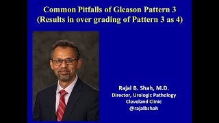 Common Pitfalls of Gleason Pattern 3 Overgrading of Pattern 3 as 4 [upl. by Edialeda363]