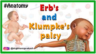 Erbs palsy and klumpkes palsy USMLE Animation  Etiology Clinical features Diagnosis Treatment [upl. by Anorahs]