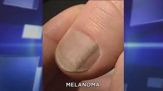 Subungual Melanoma What You Need to Know [upl. by Amabil688]