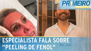 Dermatologista explica como funciona o “peeling de fenol”  Primeiro Impacto 040624 [upl. by Terr]