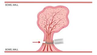 HCC 147517c Hot Snare Pedunculated polyp [upl. by Euqinamod]