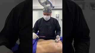 Flacidez abdominal  Liposucción con Renuvion Cirugíaplástica [upl. by Dart]