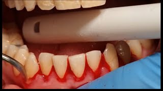 UNBELIEVABLE BLEEDING GUMS  GROSS SCALING OF TEETH [upl. by Aehsan]