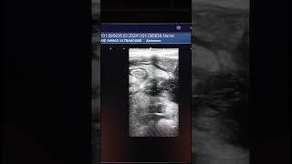 Acute appendicitis with intense periappendiceal fat stranding ultrasound appendicitis [upl. by Aiciruam]