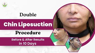 Double Chin Liposuction Procedure Before amp After Results in 10 Days  Care Well Medical Centre [upl. by Nava607]