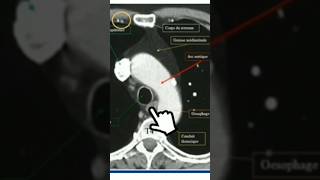 Scanner thoracique T4 anatomy medecine science anatomie scanner radiology radiologie [upl. by Adnola130]