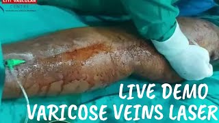 Laser Treatment for Varicose Veins  Varicose veins Laser treatment Live  live EVLT surgery [upl. by Mozes]