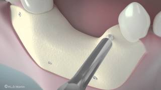 SonicWeld Rx® Dental – Shell technique for vertical defect augmentation [upl. by Klecka]